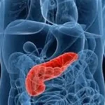 علماء يكتشفون رابط غير متوقع بين الخرف وسرطان البنكرياس المبكر