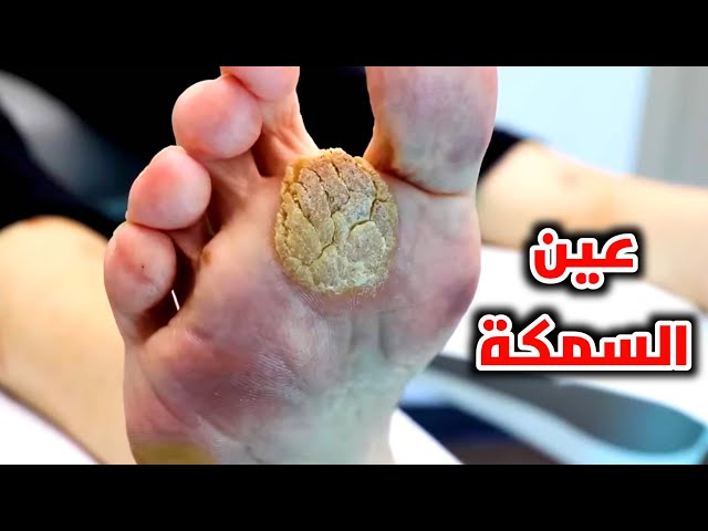كيفية إز,الة عيــ.ــون السمكة بطرق طبيــ.ــعية وسهلة